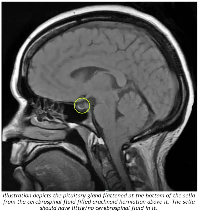 Mengenal Lebih Dekat Apa Itu Empty Sella Syndrome Read More   Empty Sella Syndrome.webp